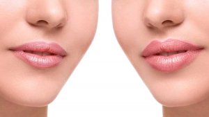 Dermal Fillers – A Natural Look post image